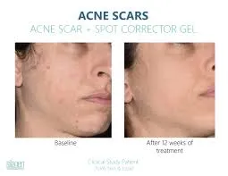 Silagen Acne Scar   Spot Corrector 30g